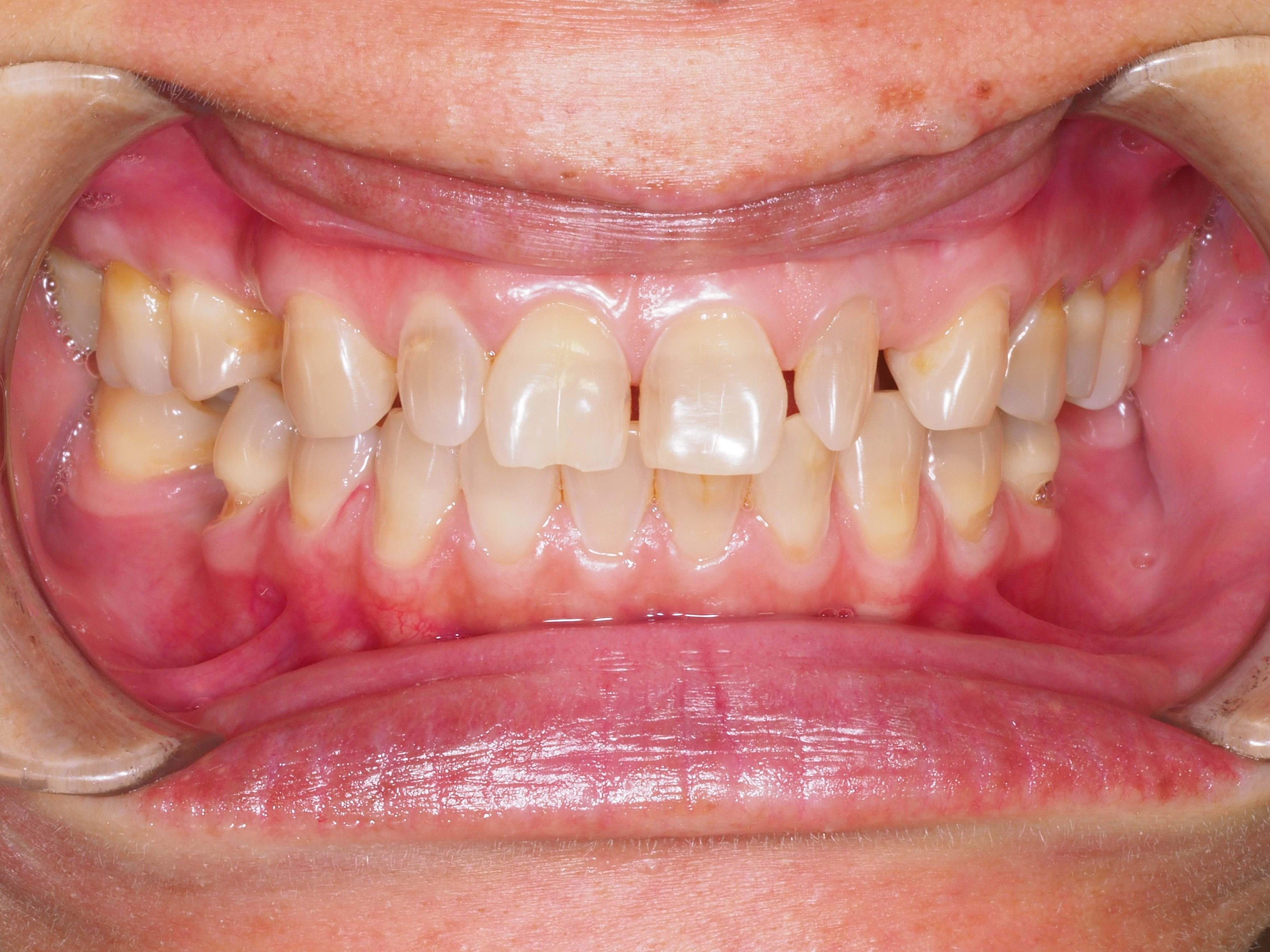 Before Invisalign
